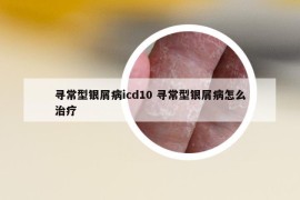 尋常型銀屑病icd10 尋常型銀屑病怎么治療