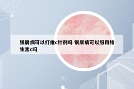 銀屑病可以打維c針劑嗎 銀屑病可以服用維生素c嗎