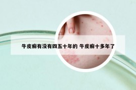 牛皮癬有沒有四五十年的 牛皮癬十多年了