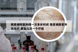 銀屑病照紫外線一次多長時間 銀屑病做紫外線光療,要做幾次一個療程