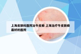 上海皮膚科醫(yī)院冶牛皮癬 上海治療牛皮膚癬最好的醫(yī)院