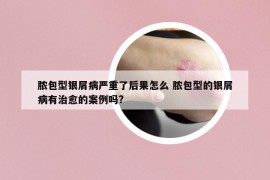 膿包型銀屑病嚴(yán)重了后果怎么 膿包型的銀屑病有治愈的案例嗎?