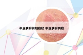 牛皮膚癬前期癥狀 牛皮膚癬的癥