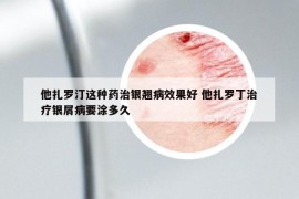 他扎羅汀這種藥治銀翹病效果好 他扎羅丁治療銀屑病要涂多久