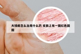大錢癬怎么治用什么藥 皮膚上有一圈紅色圓圈