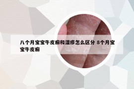 八個(gè)月寶寶牛皮癬和濕疹怎么區(qū)分 8個(gè)月寶寶牛皮癬