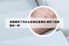 皮膚癬好了為什么皮膚還是黑的 癬好了皮膚變白一塊