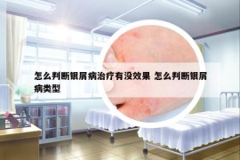 怎么判斷銀屑病治療有沒(méi)效果 怎么判斷銀屑病類型
