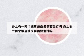 身上有一兩個銀屑病皮損需要治療嗎 身上有一兩個銀屑病皮損需要治療嗎