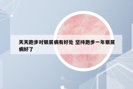 天天跑步對銀屑病有好處 堅持跑步一年銀屑病好了