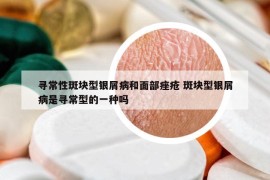 尋常性斑塊型銀屑病和面部痤瘡 斑塊型銀屑病是尋常型的一種嗎