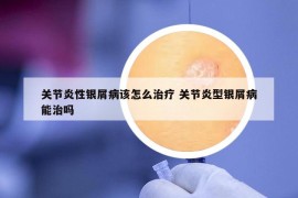 關節(jié)炎性銀屑病該怎么治療 關節(jié)炎型銀屑病能治嗎