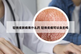 輕微皮膚癬用什么藥 輕微皮癬可以自愈嗎