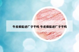 牛皮癬能進(jìn)廠子干嗎 牛皮癬能進(jìn)廠子干嗎