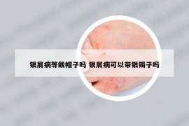 銀屑病等戴帽子嗎 銀屑病可以帶銀鐲子嗎