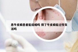 患牛皮癬患者能結(jié)婚嗎 得了牛皮癬能過性生活嗎