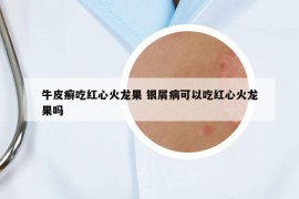 牛皮癬吃紅心火龍果 銀屑病可以吃紅心火龍果嗎