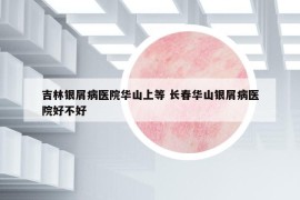 吉林銀屑病醫(yī)院華山上等 長(zhǎng)春華山銀屑病醫(yī)院好不好