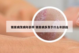 銀屑病發(fā)病年齡早 銀屑病多發(fā)于什么年齡段