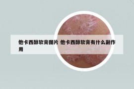 他卡西醇軟膏圖片 他卡西醇軟膏有什么副作用