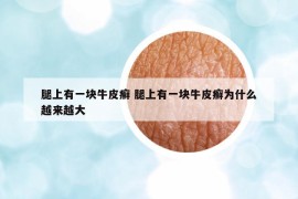 腿上有一塊牛皮癬 腿上有一塊牛皮癬為什么越來越大