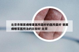 北京市銀屑病哪里醫(yī)院最好的醫(yī)院最好 銀屑病哪家醫(yī)院治的比較好 北京