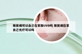 銀屑病可以自己在家做UVB嗎 銀屑病在家自己光療可以嗎