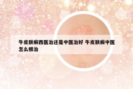 牛皮膚癬西醫(yī)治還是中醫(yī)治好 牛皮膚癬中醫(yī)怎么根治