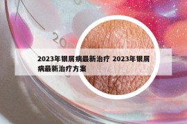 2023年銀屑病最新治療 2023年銀屑病最新治療方案