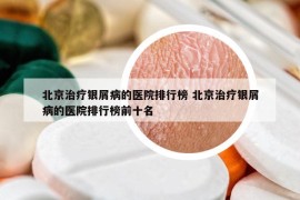 北京治療銀屑病的醫(yī)院排行榜 北京治療銀屑病的醫(yī)院排行榜前十名