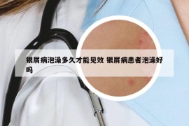 銀屑病泡澡多久才能見效 銀屑病患者泡澡好嗎