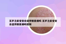 五歲之前寶寶會遺傳銀屑病嗎 五歲之前寶寶會遺傳銀屑病嗎視頻