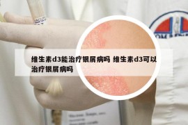 維生素d3能治療銀屑病嗎 維生素d3可以治療銀屑病嗎