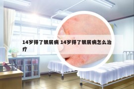 14歲得了銀屑病 14歲得了銀屑病怎么治療