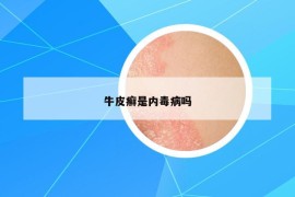 牛皮癬是內(nèi)毒病嗎
