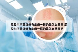 屁股溝子里瘙癢有皮癬一樣的是怎么回事 屁股溝子里瘙癢有皮癬一樣的是怎么回事啊