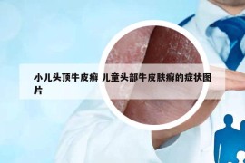 小兒頭頂牛皮癬 兒童頭部牛皮膚癬的癥狀圖片