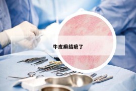 牛皮癬結(jié)疤了