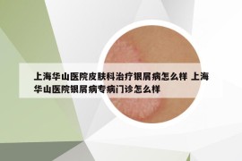 上海華山醫(yī)院皮膚科治療銀屑病怎么樣 上海華山醫(yī)院銀屑病專病門診怎么樣