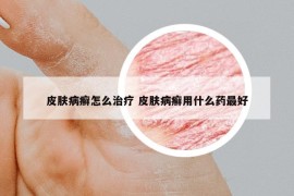 皮膚病癬怎么治療 皮膚病癬用什么藥最好