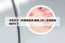 手臂長(zhǎng)了一塊像銀屑病 胳膊上的一處銀屑始終好不了