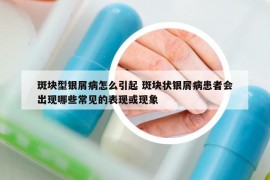 斑塊型銀屑病怎么引起 斑塊狀銀屑病患者會(huì)出現(xiàn)哪些常見(jiàn)的表現(xiàn)或現(xiàn)象