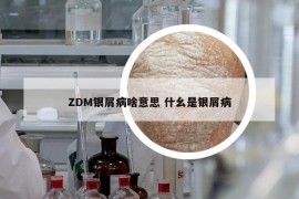 ZDM銀屑病啥意思 什幺是銀屑病