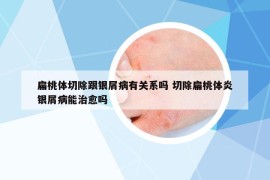 扁桃體切除跟銀屑病有關(guān)系嗎 切除扁桃體炎銀屑病能治愈嗎