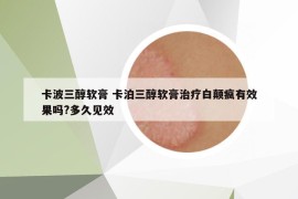 卡波三醇軟膏 卡泊三醇軟膏治療白顛瘋有效果嗎?多久見效