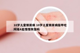 10歲兒童銀屑病 10歲兒童銀屑病指甲吃阿維A能慢慢恢復(fù)嗎