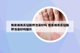 銀屑病用高錳酸鉀泡澡好嗎 銀屑病用高錳酸鉀泡澡好嗎圖片