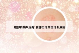 腹部白癜風(fēng)治療 腹部出現(xiàn)白斑什么原因