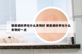 銀屑病秋季吃什么食物好 銀屑病秋季吃什么食物好一點