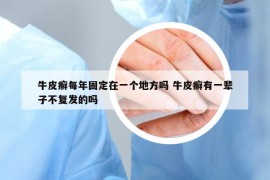 牛皮癬每年固定在一個地方嗎 牛皮癬有一輩子不復發(fā)的嗎